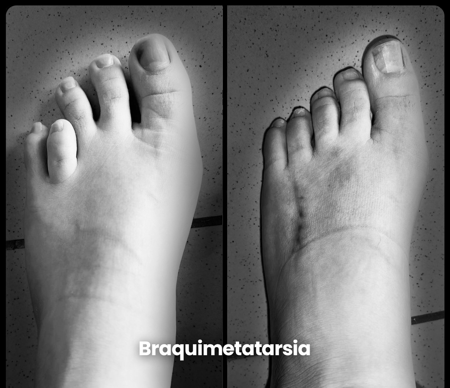 Braquimetatarsia