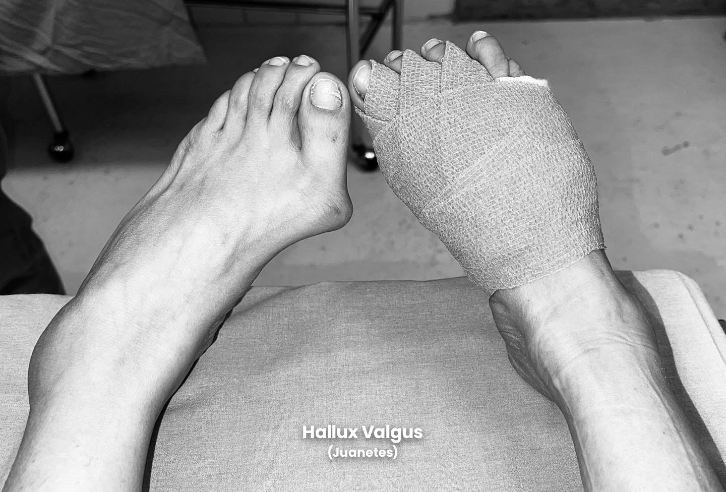 Hallux valgus o juanetes
