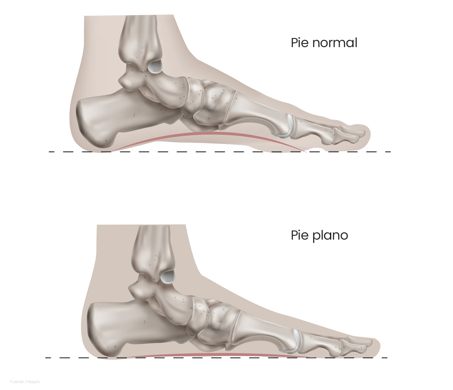 Comparación entre pie normal y pie plano